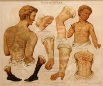 Старинная цветная медицинская гравюра «Накожные болезни», Большая энциклопедия, Россия, к. 19, н. 20 в.