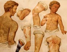 Старинная цветная медицинская гравюра «Накожные болезни», Большая энциклопедия, Россия, к. 19, н. 20 в.