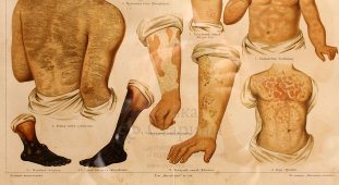 Старинная цветная медицинская гравюра «Накожные болезни», Большая энциклопедия, Россия, к. 19, н. 20 в.