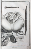Старинная медицинская гравюра «Хирургия», Франция, 18 в.