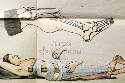 Учебное наглядное пособие «Вывихи и переломы костей», авторы Кабанов А. Н. и Беляев В. А., художник Оболенский С. Г., 1962 г.