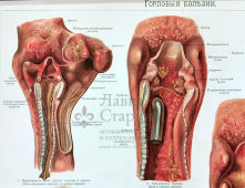 Старинная цветная медицинская гравюра в раме «Болезни горла», Россия, н. 20 в.