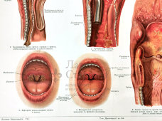 Старинная цветная медицинская гравюра в раме «Болезни горла», Россия, н. 20 в.